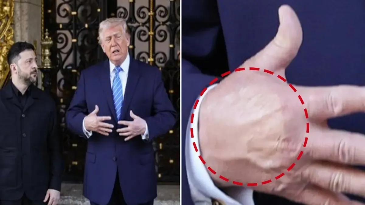 Trump’s Hidden Illness Sparks Global Buzz
