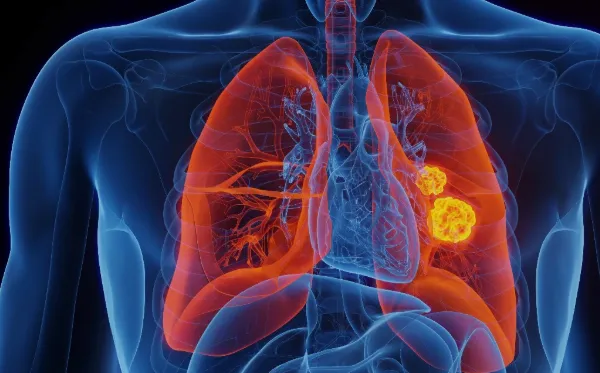 India’s Lung Cancer Burden 