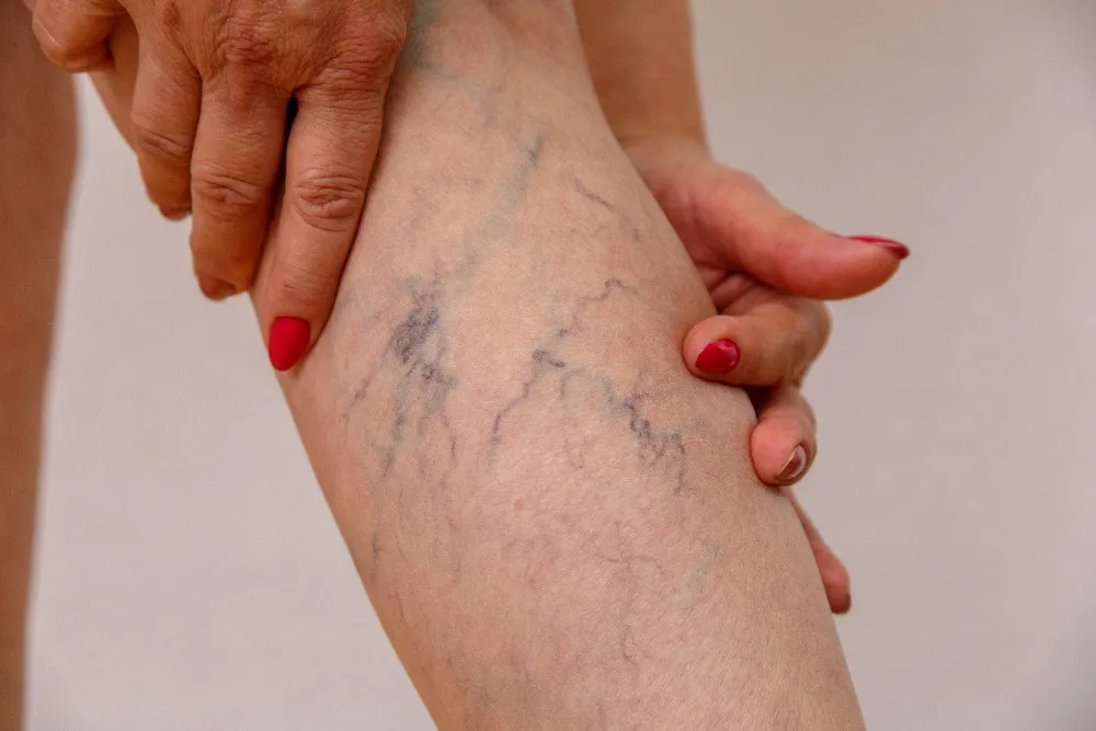 Visible Blue Veins