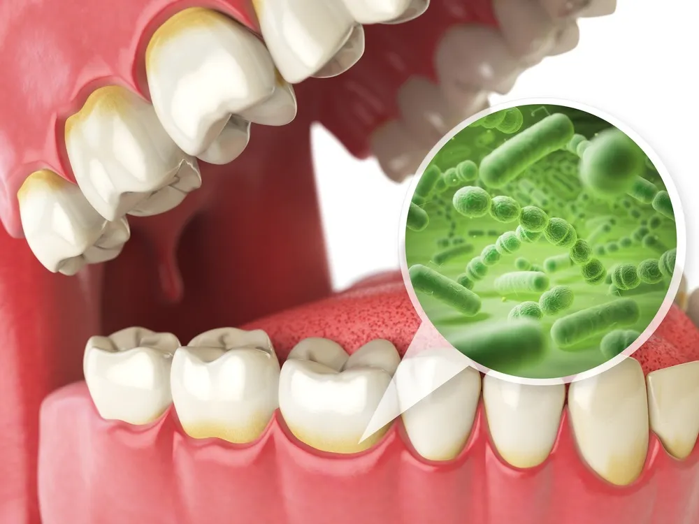 gum disease heart attack